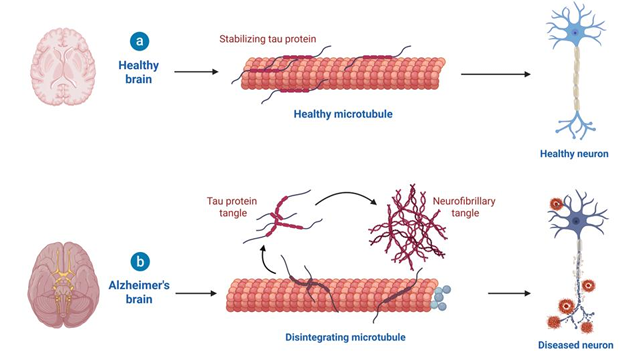 Artificial Intelligence-Driven Formulation Strategies for Targeted Drug Delivery in Alzheimer's Disease: Bridging Pharmaceutics and Precision Medicine