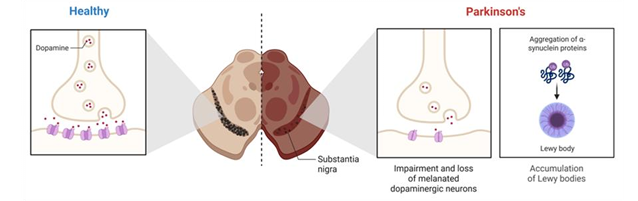 Smart Diagnosis and Treatment of Parkinson’s Disease Using Artificial Intelligence: Enhancing Motor Symptom Tracking and Deep Brain Stimulation Control